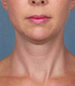 Woman treated with Kybella before 2061774