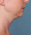 Woman treated with Kybella 2061774