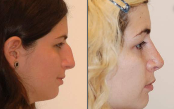 Rhinoplasty, profile view before 95079