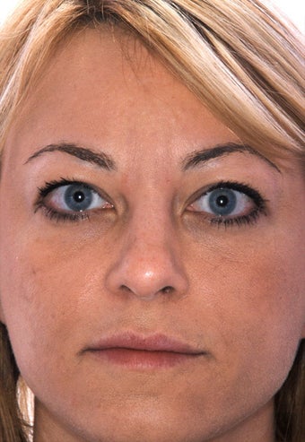 Botox after 905113
