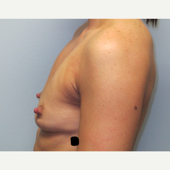 35-44 year old woman treated with Breast Augmentation before 3185811