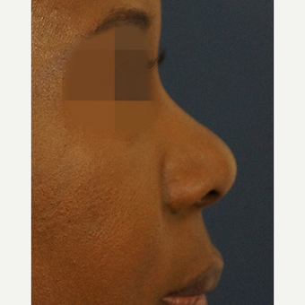 35-44 year old woman treated with Non Surgical Nose Job before 3244866