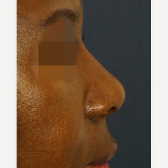 35-44 year old woman treated with Non Surgical Nose Job after 3244866