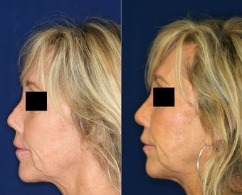 Non Surgical Nose Job before 1431730