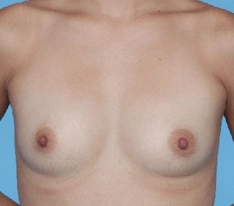 Breast augmentation with Saline implants before 67286