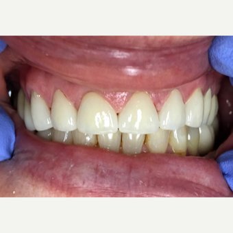55-64 year old woman treated with Dental Crown after 2780566