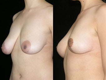 Mastopexy (breast lift) before 1053865