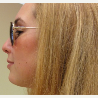 25-34 year old woman treated with Radiesse after 3744633