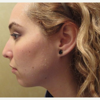 25-34 year old woman treated with Radiesse before 3744633
