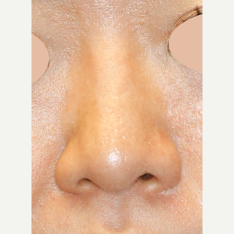Asian Rhinoplasty To Augmentin Bridge, Project Tip an Narrow Nostrils after 3672422
