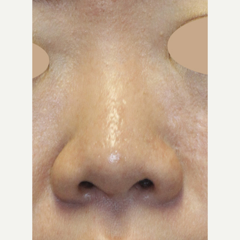 Asian Rhinoplasty To Augmentin Bridge, Project Tip an Narrow Nostrils before 3672422
