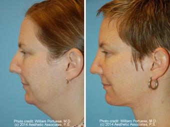 Neck Liposuction before 1389502