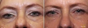 Laser Resurfacing before 342196