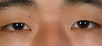 Asian Eyelid Surgery before 1208019
