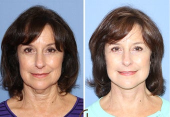 Neck Lift Performed Under Local Anesthesia 252433