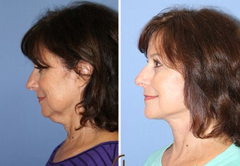 Neck Lift Performed Under Local Anesthesia 252433