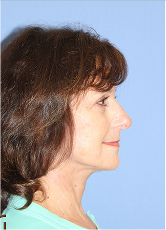 Neck Lift Performed Under Local Anesthesia after 252433