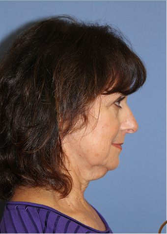Neck Lift Performed Under Local Anesthesia before 252433