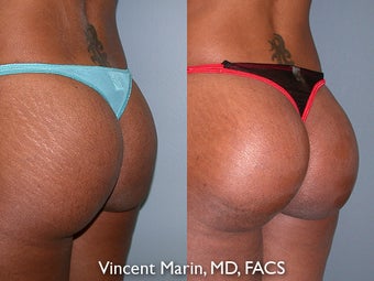 Buttock Implants after 990838