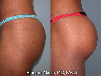 Buttock Implants before 990838