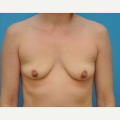 25-34 year old woman treated with Breast Augmentation before 3669230