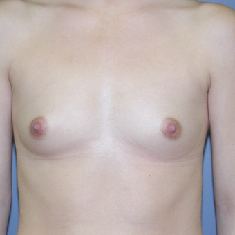 26 year old woman treated with Breast Augmentation before 3041718