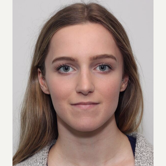25-34 year old woman treated with Rhinoplasty after 3224737