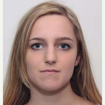 25-34 year old woman treated with Rhinoplasty before 3224737