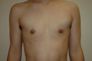 Transgender, female to male. Removal gland and nipple reduction. after 1130371