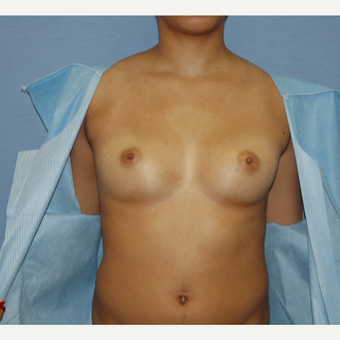 25-34 year old woman treated with Breast Augmentation before 3124677