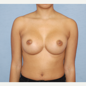 25-34 year old woman treated with Breast Augmentation after 3124677