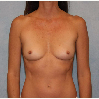 45-54 year old woman treated with Breast Augmentation before 3487447