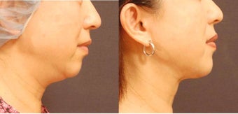 Chin Liposuction before 693090