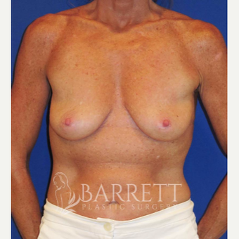 55-64 year old woman treated with Breast Lift before 3584139