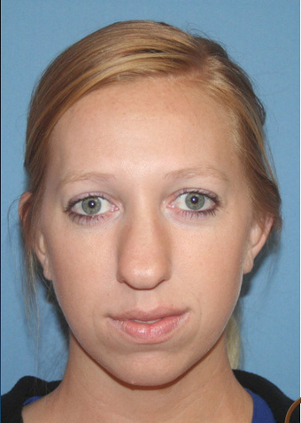 Ethnic Rhinoplasty before 1357629
