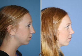 Ethnic Rhinoplasty 1357629