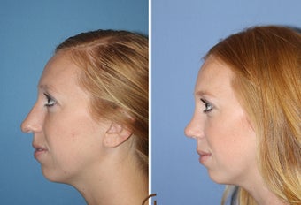 Ethnic Rhinoplasty 1357629