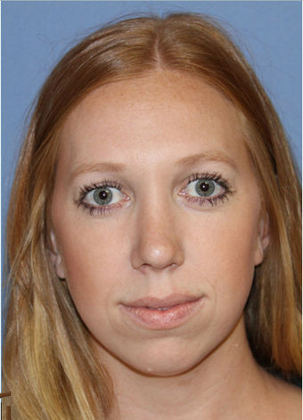 Ethnic Rhinoplasty after 1357629