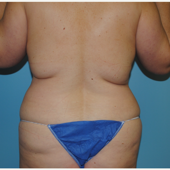 35-44 year old woman treated with Liposuction before 3069299