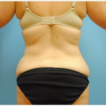 35-44 year old woman treated with Liposuction after 3069299