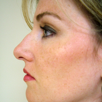 35-44 year old woman treated with Rhinoplasty before 3320876