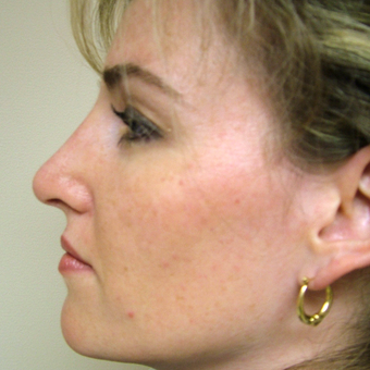 35-44 year old woman treated with Rhinoplasty after 3320876