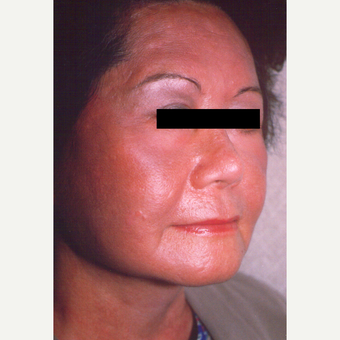 55-64 year old woman treated with Chemical Peel after 3543512