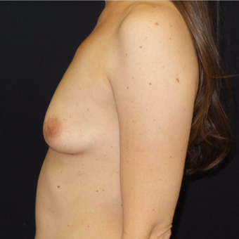 35-44 year old woman treated with Breast Augmentation before 3493840