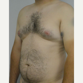 25-34 year old man treated with Male Breast Reduction before 3175419