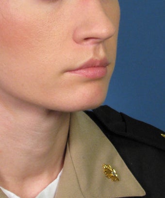 Subnasale Upper Lip Lift Shortening Procedure 1155077