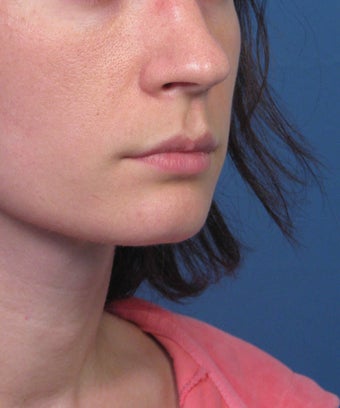 Subnasale Upper Lip Lift Shortening Procedure after 1155077