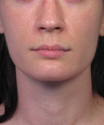 Subnasale Upper Lip Lift Shortening Procedure before 1155077