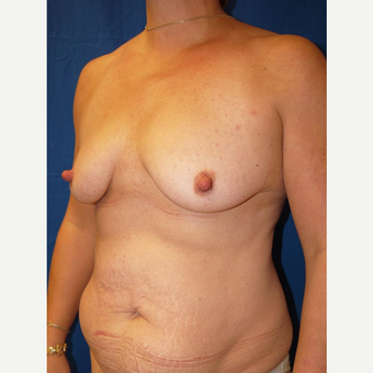 Breast Augmentation before 3744223