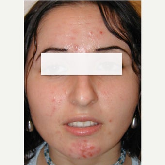 Blue Light Acne Phototherapy (iClearXL, Curelight Medical). before 1561699